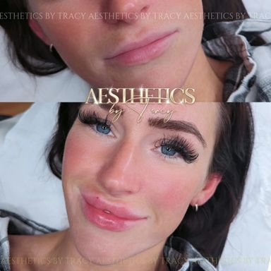 Dermal Filler