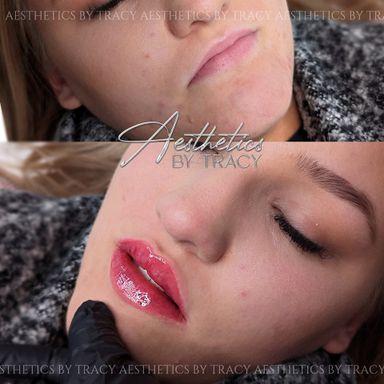 Lip Augmentation