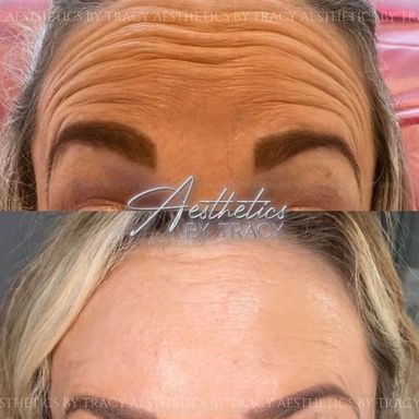 Anti Wrinkle