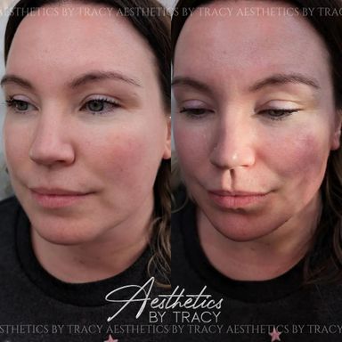 Jaw & Chin Filler