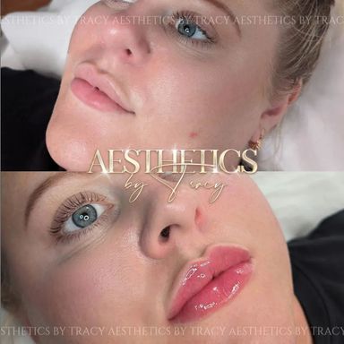 Dermal Filler