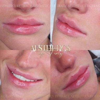 Dermal Filler