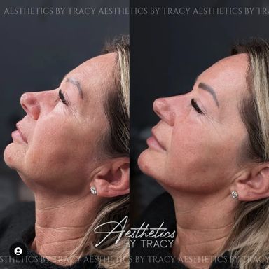 Jaw & Chin Filler