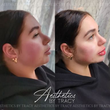Chin & Jaw Filler