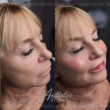 Cheek Filler