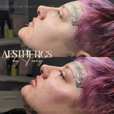 Cheek Filler